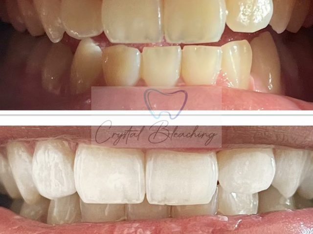 centre de blanchiment dentaire Crystal Bleaching - Agadir - +212 661-070642