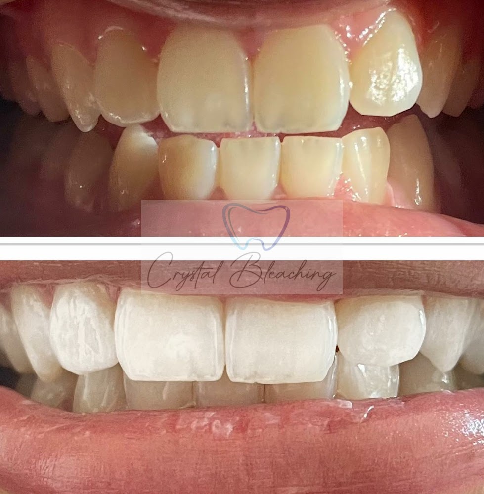centre de blanchiment dentaire Crystal Bleaching