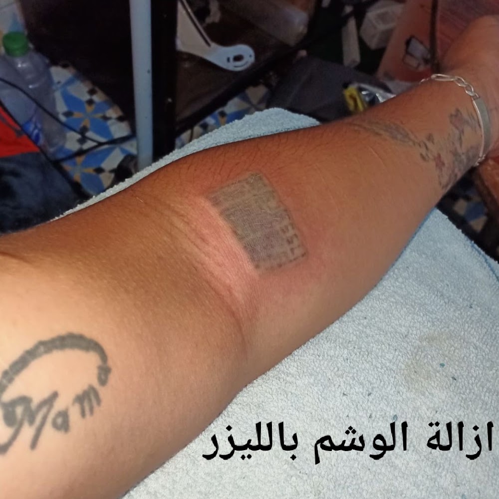 detatouage laser - Marrakech