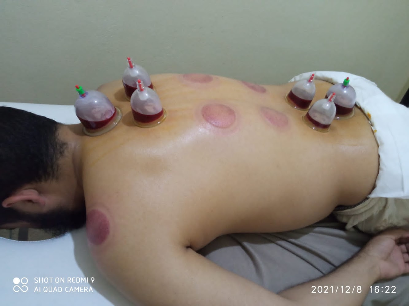 الحجامة والاعشاب الطبية