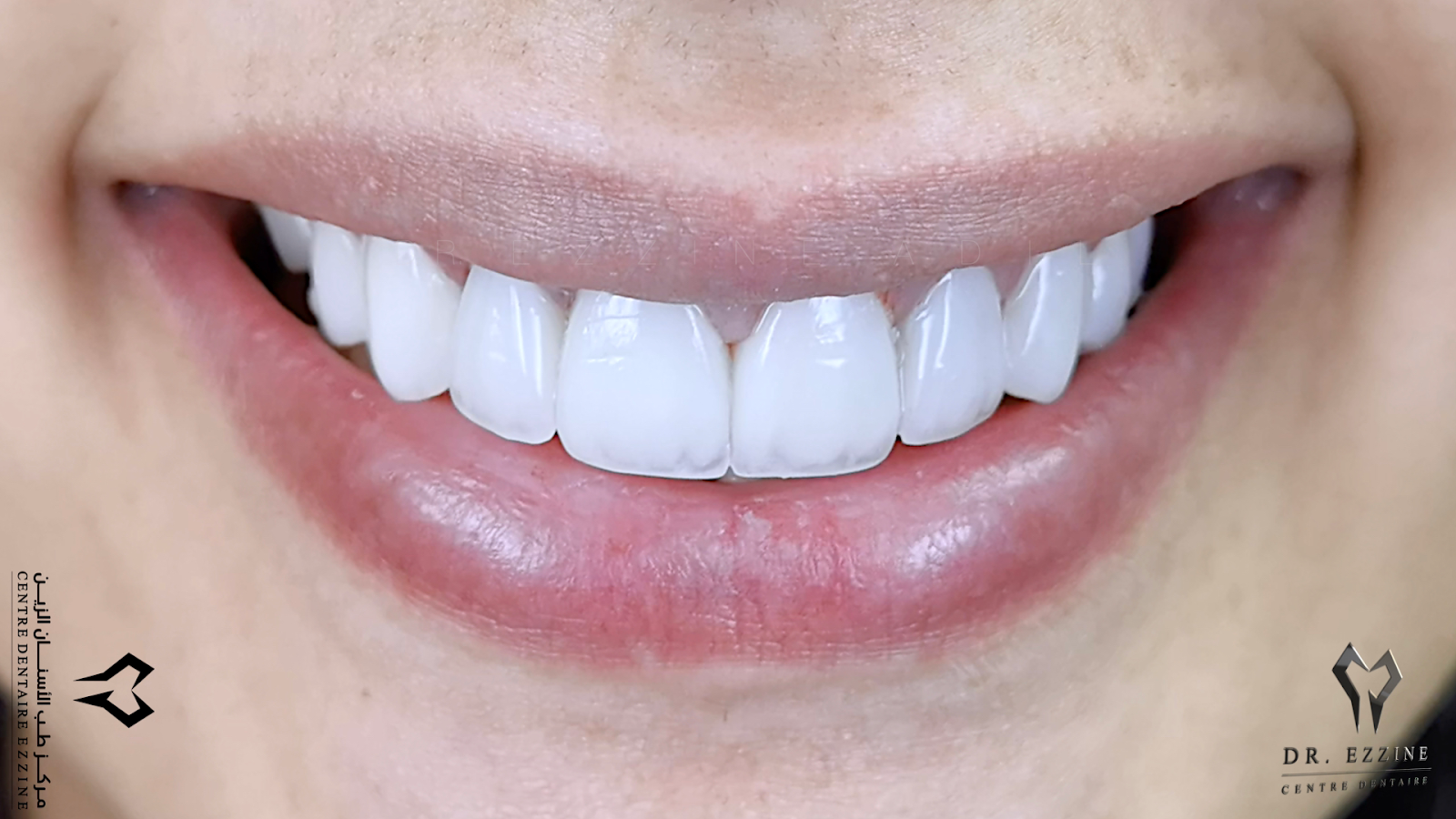 Centre Dentaire Ezzine - Salé