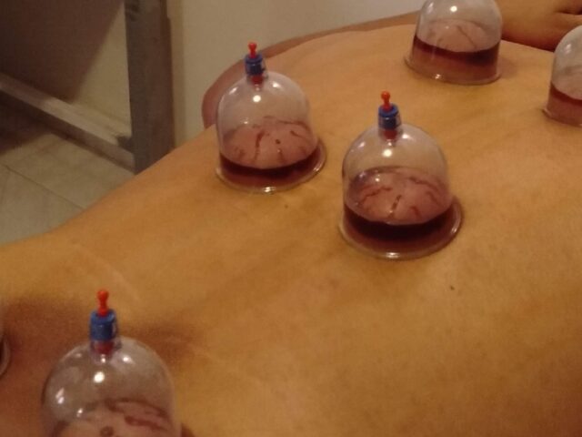 Cabinet Assafaa de kinésithérapie physiothérapie hijama amincissement ''yesotherapie'' عيادة الصفاء لترويض الطبي و العلاج الفيزيائي والحجامة و التخسيس - Témara - +212 660-746902